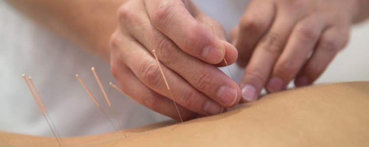 Acupuncture treatments